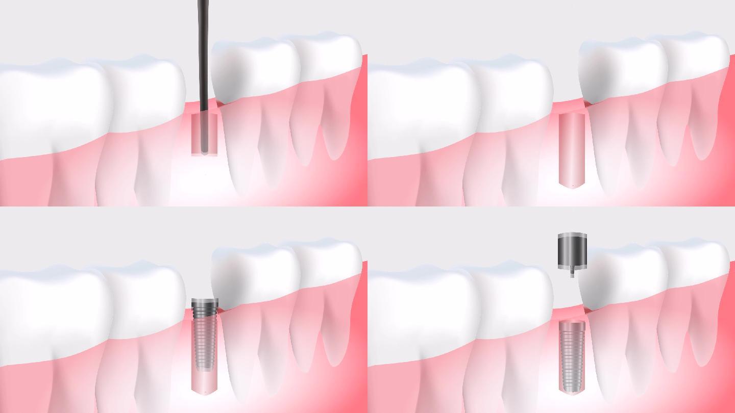 牙科种植牙过程演示