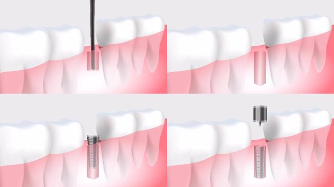 牙科种植牙过程演示