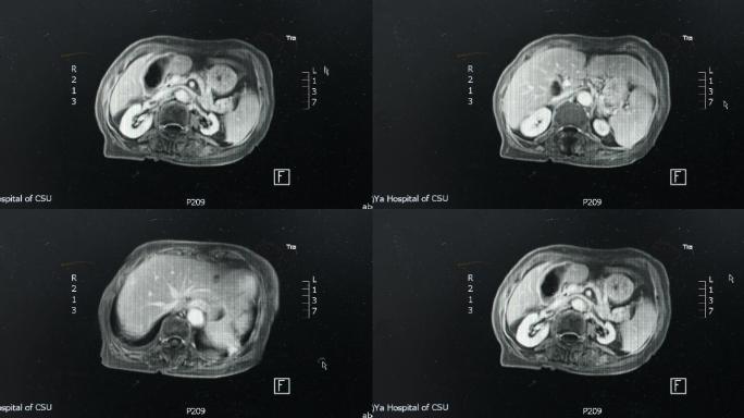 【4K】CT肿瘤筛查镜头