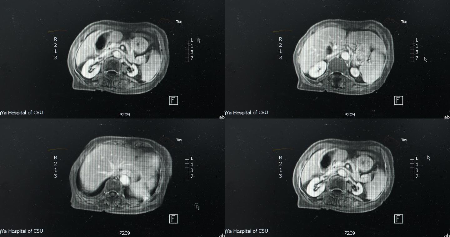 【4K】CT肿瘤筛查镜头