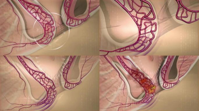 人类直立和脏器压迫肛周静脉曲张形成痔疮