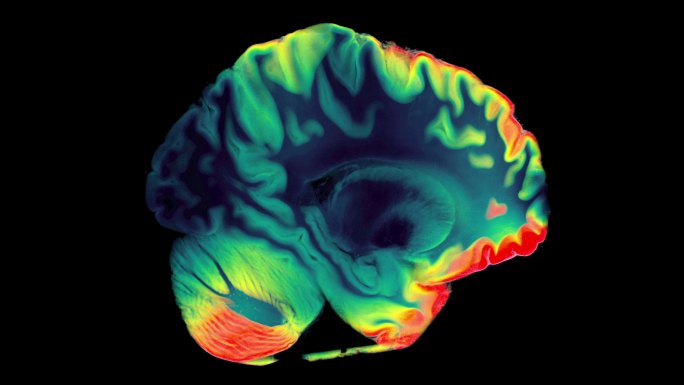 大脑动脉的磁共振脑血管造影