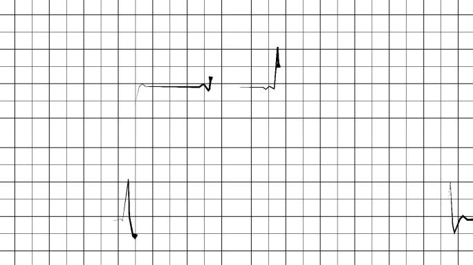 心电图医疗监护仪动画