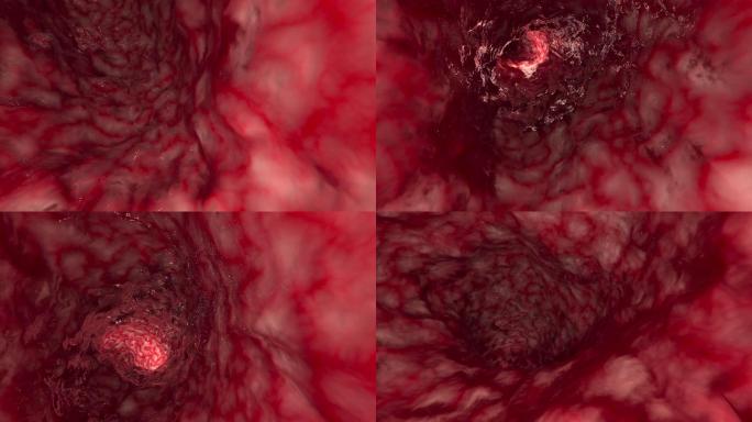 动脉或肠内医疗健康消化道系统血管穿梭