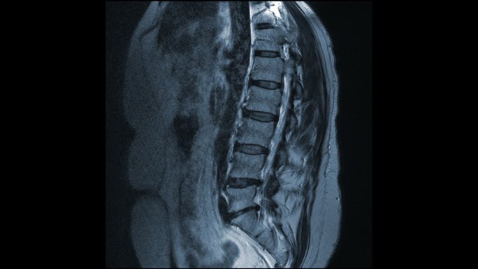 MRI显示椎间盘突出动画