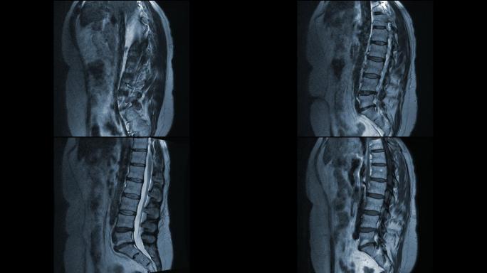 MRI显示椎间盘突出动画