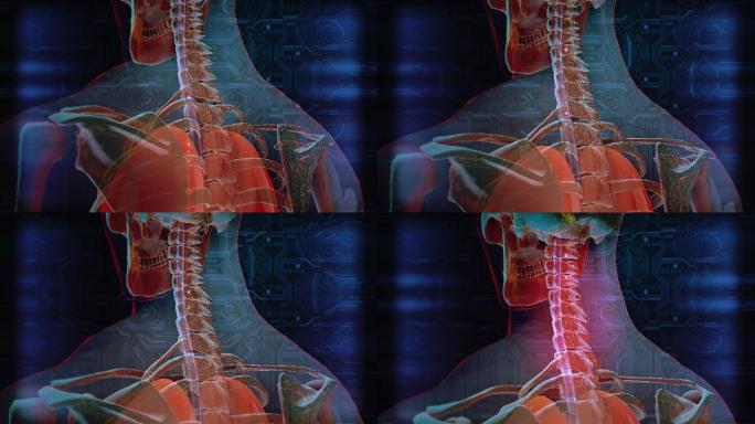 颈椎病三维3d模拟脊椎病痛演示