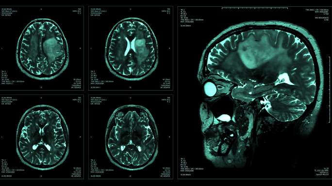 脑磁共振扫描显示CT拍片片子脑部大脑