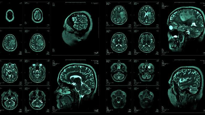 脑磁共振扫描显示CT拍片片子脑部大脑