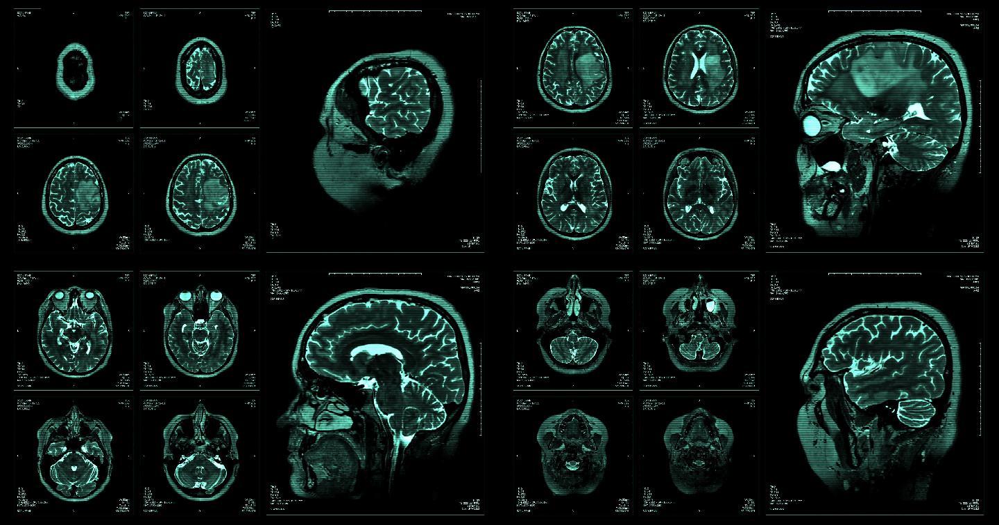 脑磁共振扫描显示CT拍片片子脑部大脑