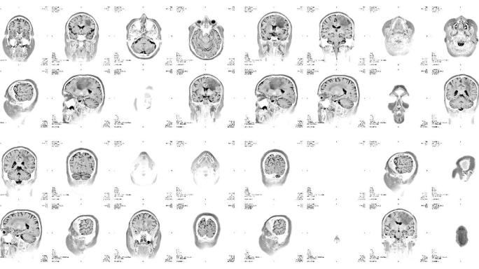 核磁共振成像特效大脑内部