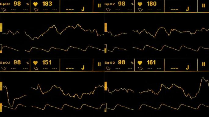 心电监护仪重症监护室ICU面板界面