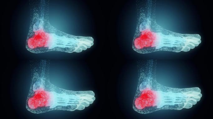 人体足部的跟腱组织器官脚部疾病关节炎