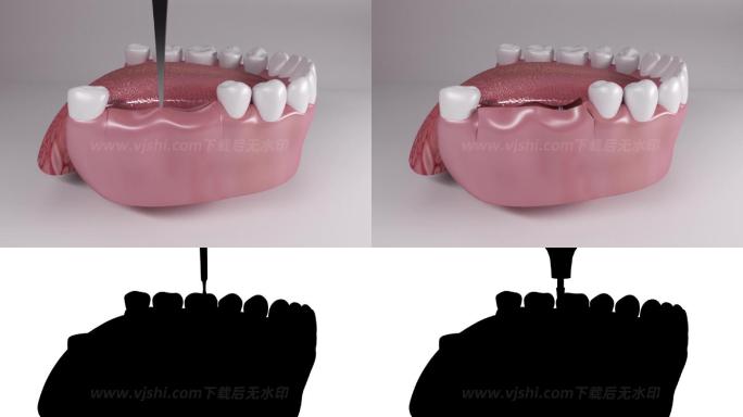 口腔牙龈种牙修复手术3d动画/附黑白遮罩