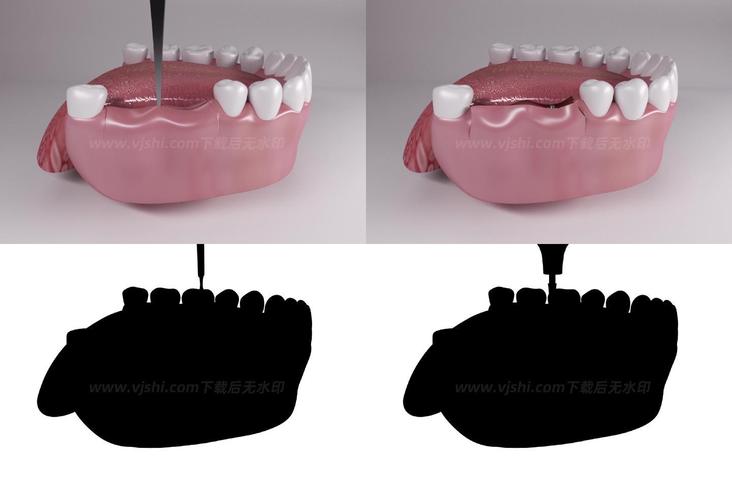 口腔牙龈种牙修复手术3d动画/附黑白遮罩