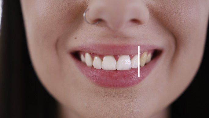 一位微笑的年轻女子正在美白牙齿