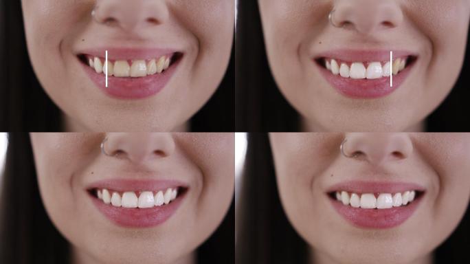一位微笑的年轻女子正在美白牙齿
