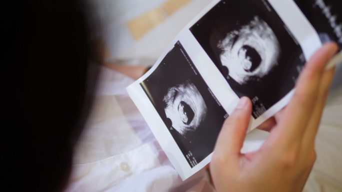 超声波扫描图B超照片产检怀孕
