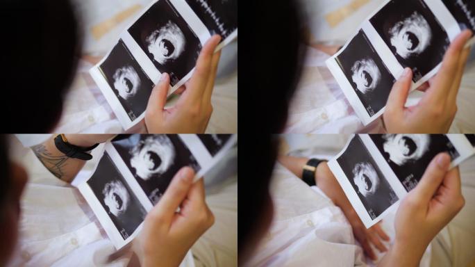 超声波扫描图B超照片产检怀孕