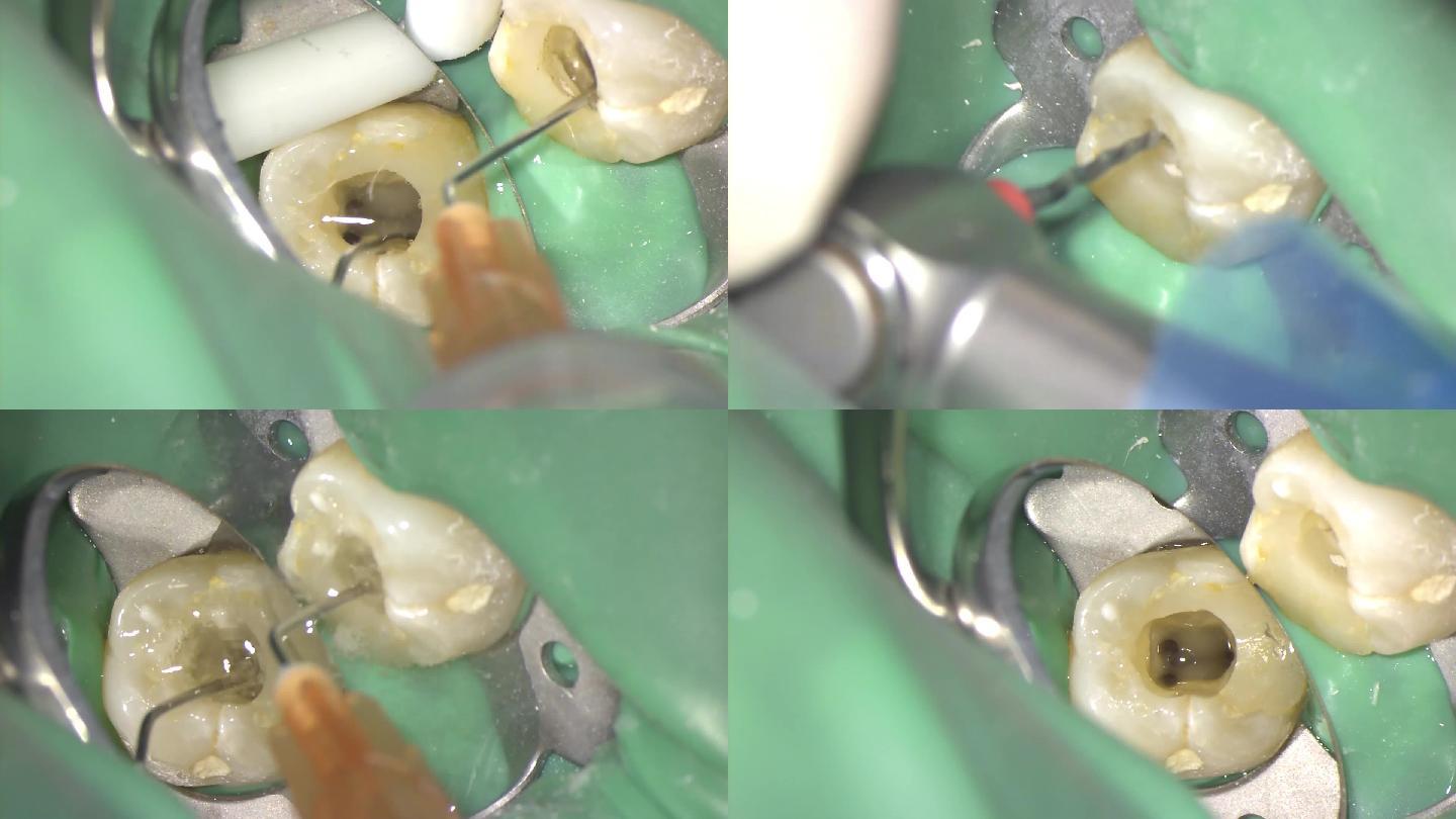 口腔中心牙科牙医显微镜视频修牙补牙实拍