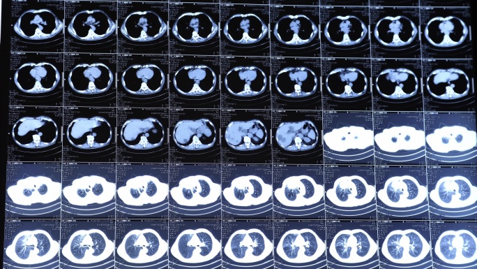 【4K】CT肿瘤影像图