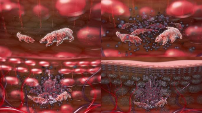 表皮内寄生癣虫分泌毒蛋白堆积鳞屑形成癣病
