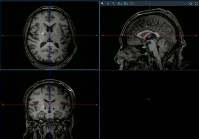 DBS手术后脑部MRI核磁影像