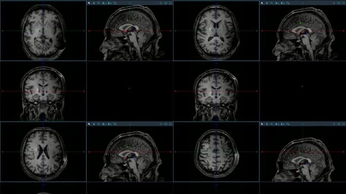 DBS手术后脑部MRI核磁影像