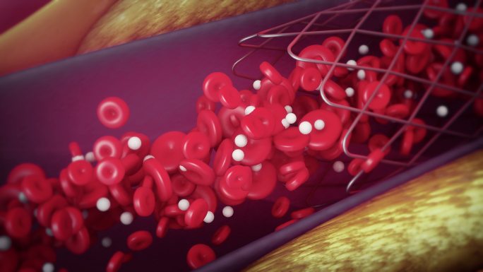 球囊血管成形术特效医疗技术