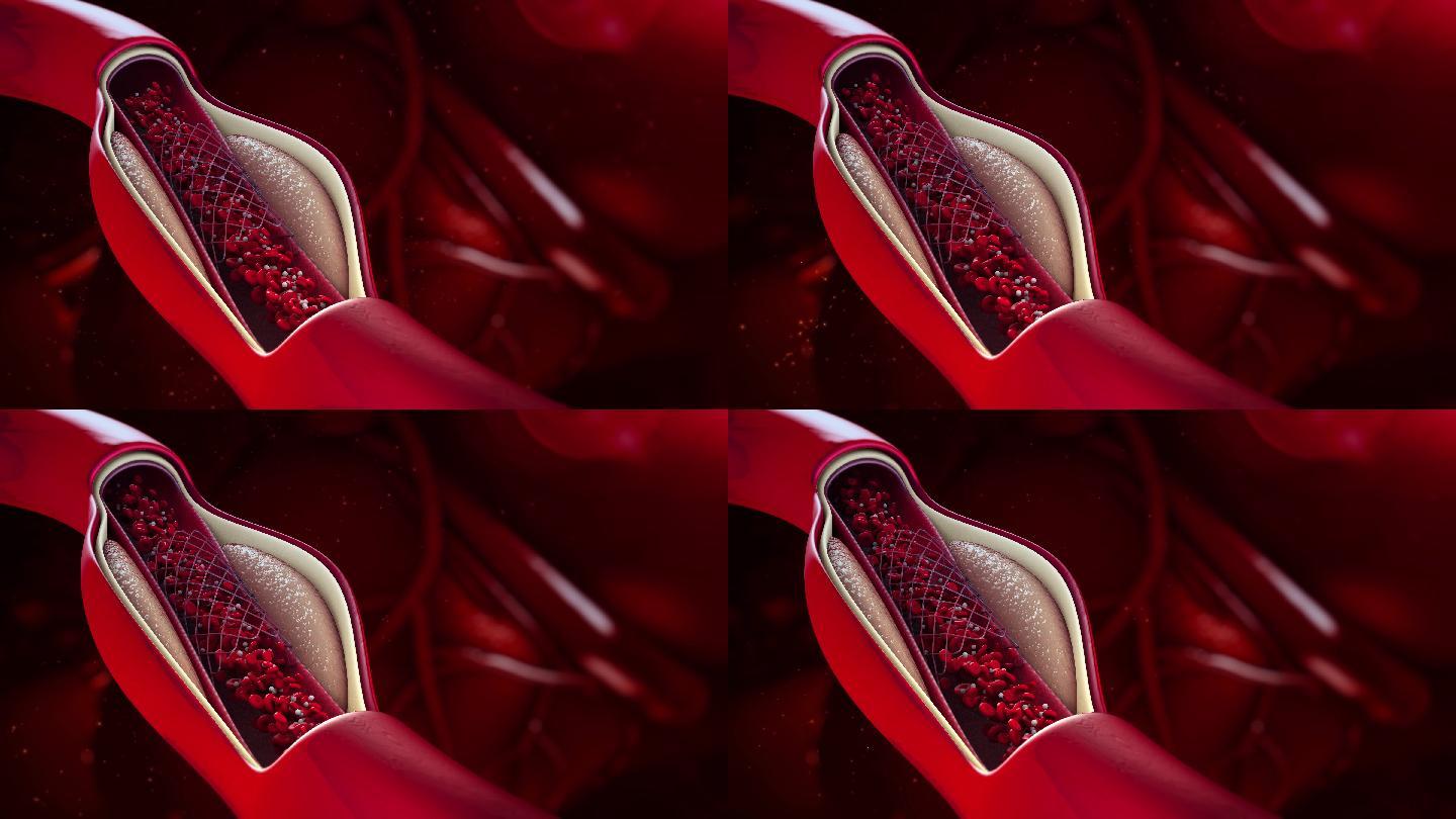 球囊血管成形术血红蛋白特效视频3D