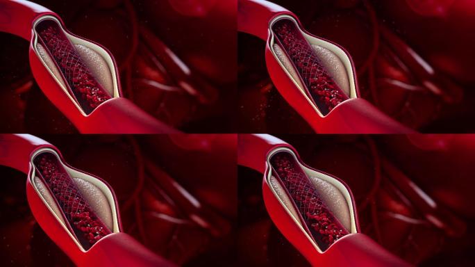 球囊血管成形术血红蛋白特效视频3D