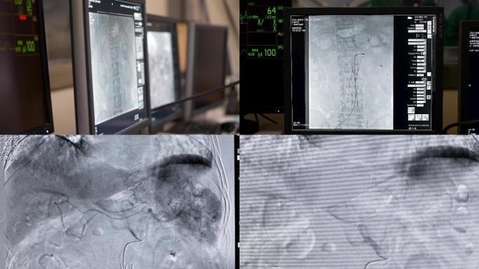 4K介入科反射做造影手术造影血管穿刺