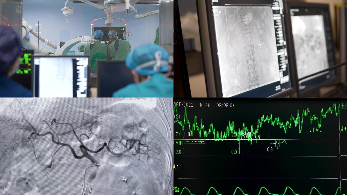 4K介入放射科造影手术血管穿刺手术合集2