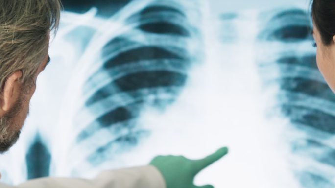 科学家正在观察感染了冠状病毒delta变种的人类肺部X光片。闭合。
