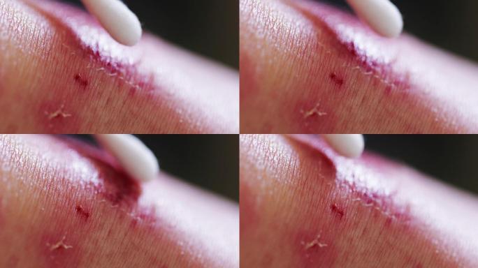 酒精棉签清洁伤口