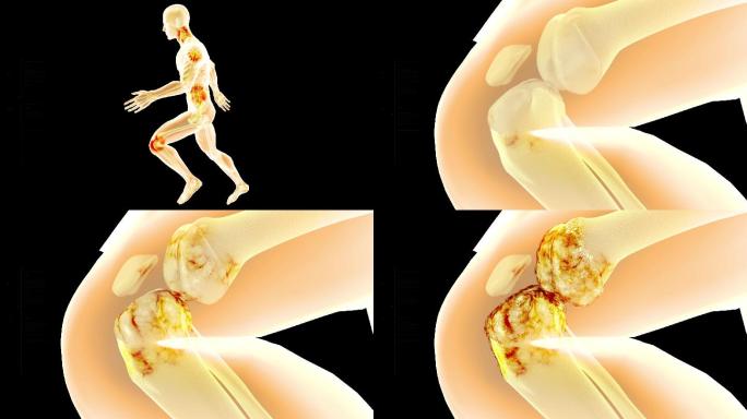 颈肩腰腿痛骨病产生