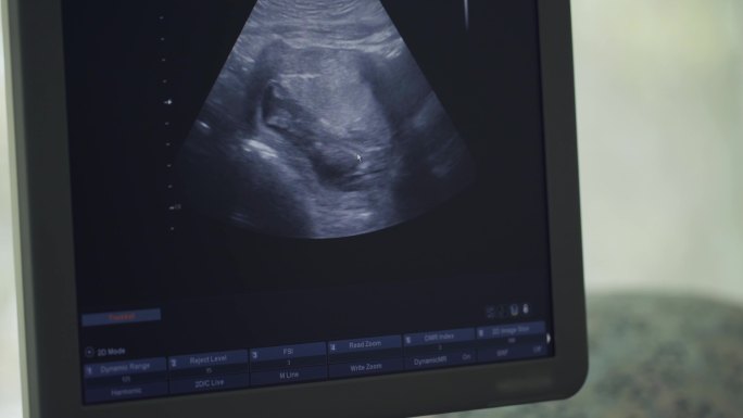 超声波检查时婴儿在母亲肚子里