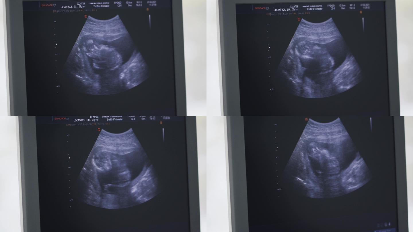 超声波检查时婴儿在母亲肚子里