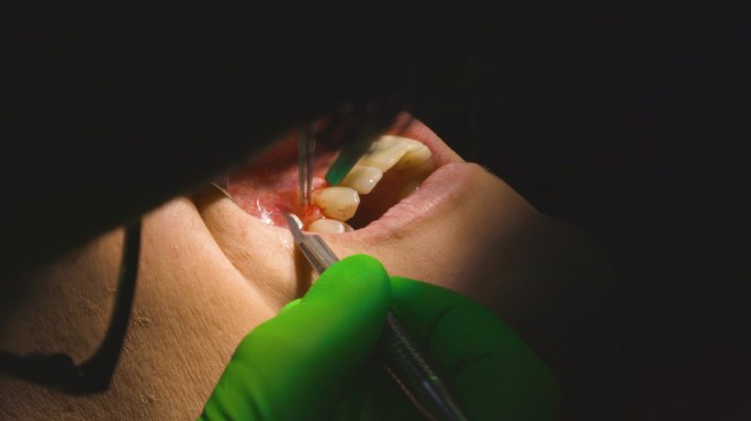 牙科介入手术牙周炎
