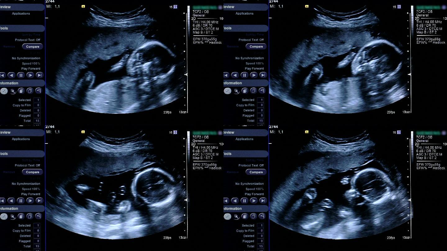 计算机显示器上的人类胚胎。体外受精。