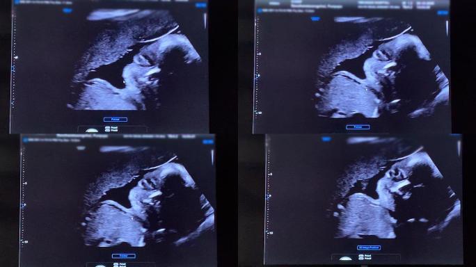 怀孕婴儿的超声波扫描。