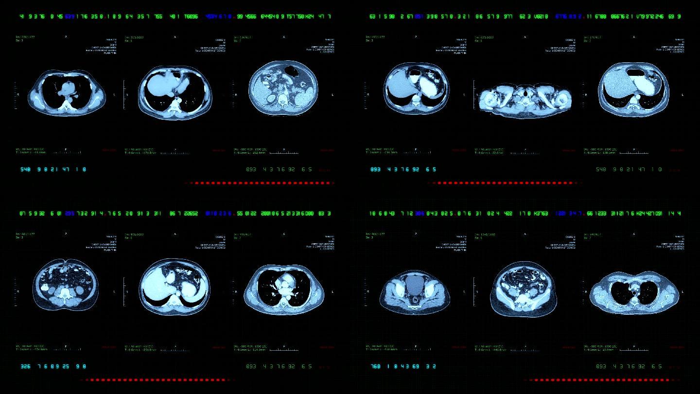 胸部和腹部MRI扫描