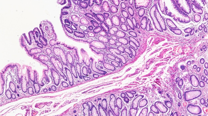 显微镜下肠道腺瘤病人体病理标本