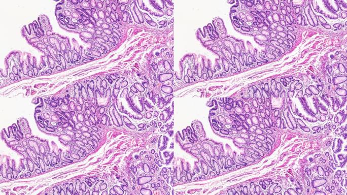 显微镜下肠道腺瘤病人体病理标本