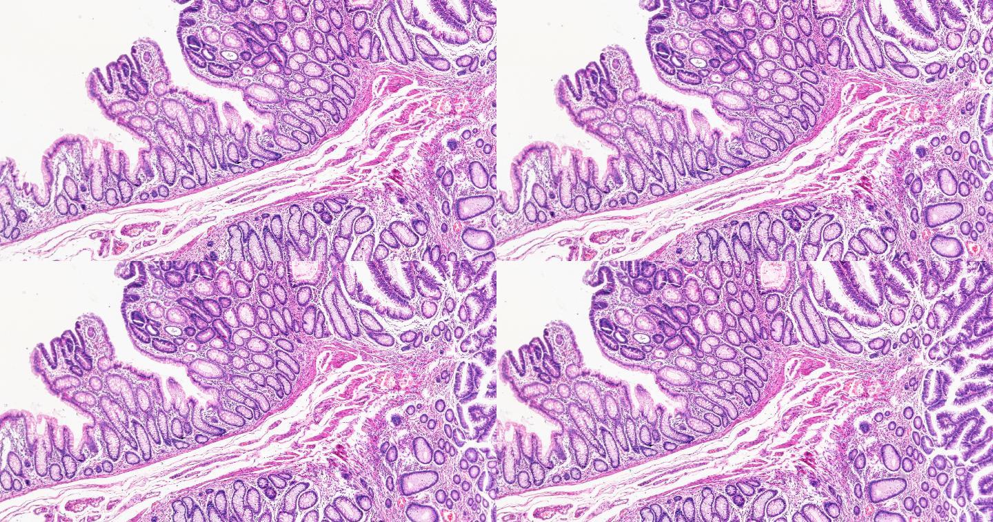显微镜下肠道腺瘤病人体病理标本
