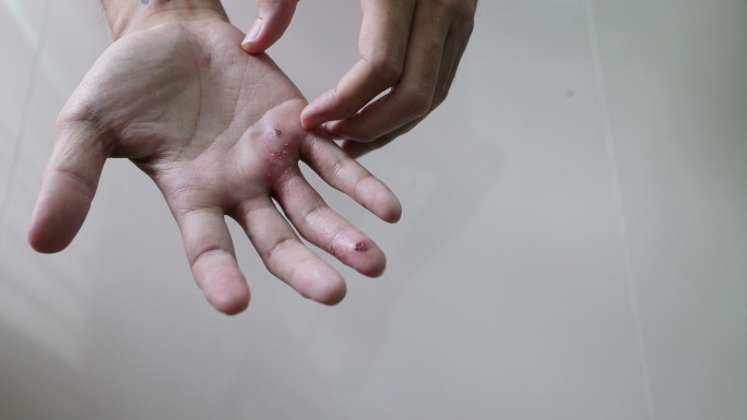 亚洲男人在手上感到瘙痒和抓痒，医疗和保健上有疤痕