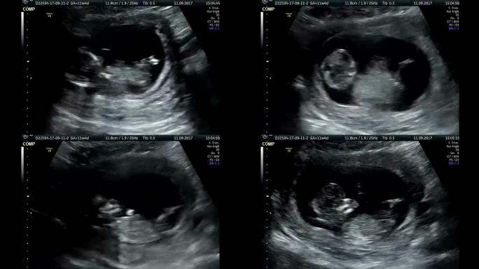 婴儿超声波检查B超彩超子宫
