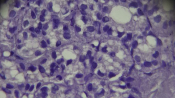 甲状腺癌显微镜活检