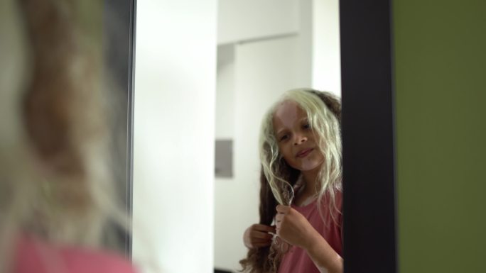 一个患有白癜风的女孩在家照镜子