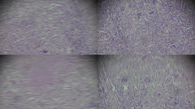 显微镜下人类粟粒性结核活检玻片不同区域的放大